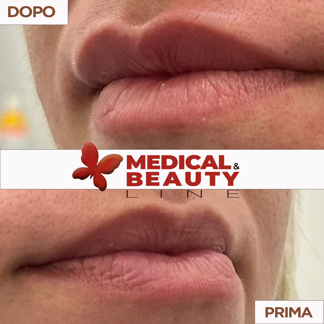 confronto della bocca con il prima e dopo trattamento Filler per verifica del risultato ottenuto di labbra più piene e sensuali,